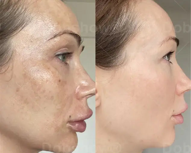 Melantrax Anti-Hyperpigmentation Essence