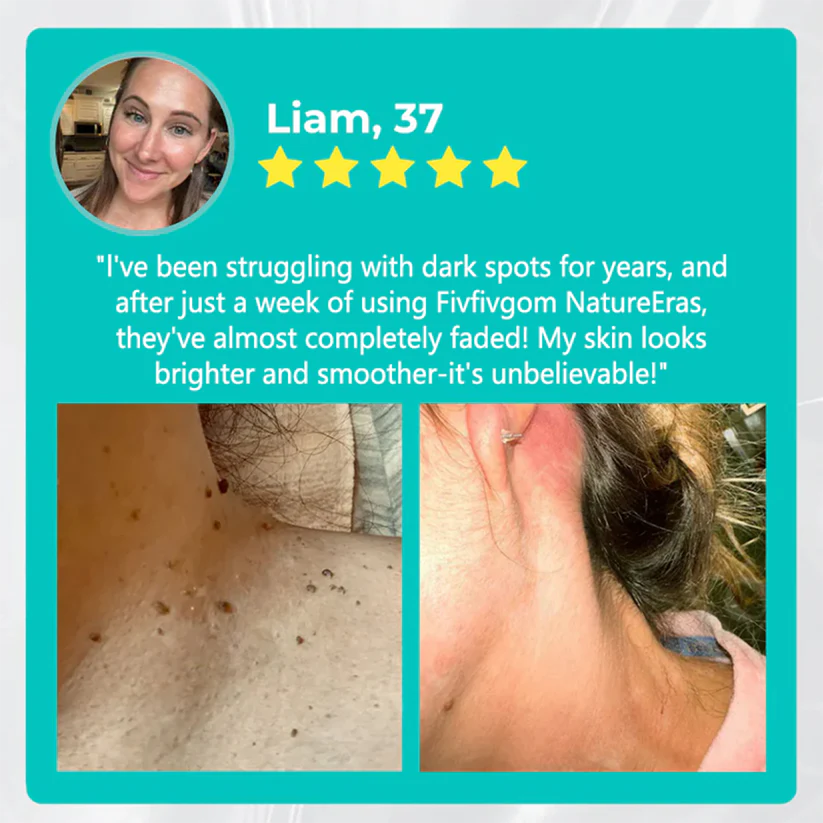 Instant Alligator Oil Mole & Spot Removal Gel