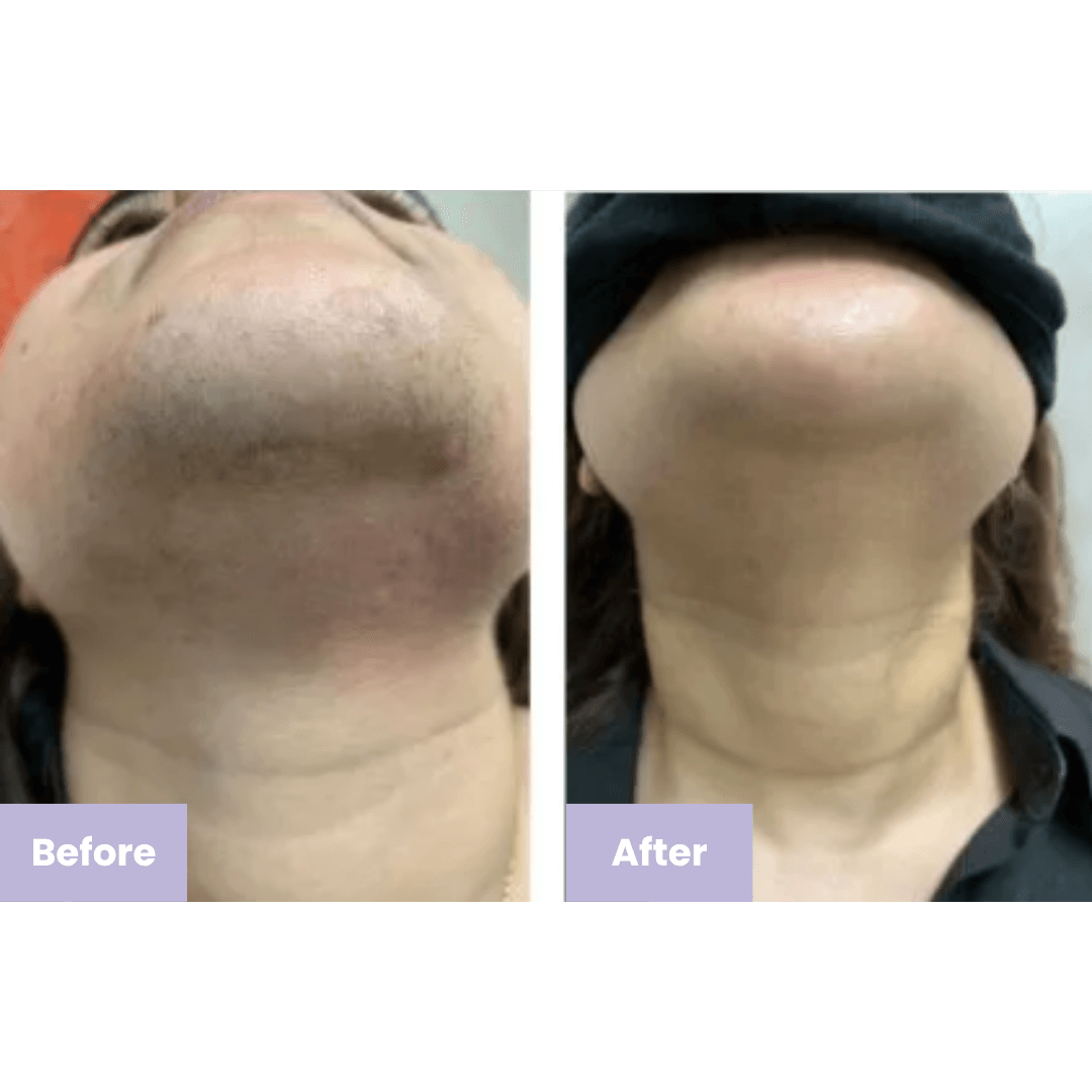 Instant Facial Hair Removing Cream