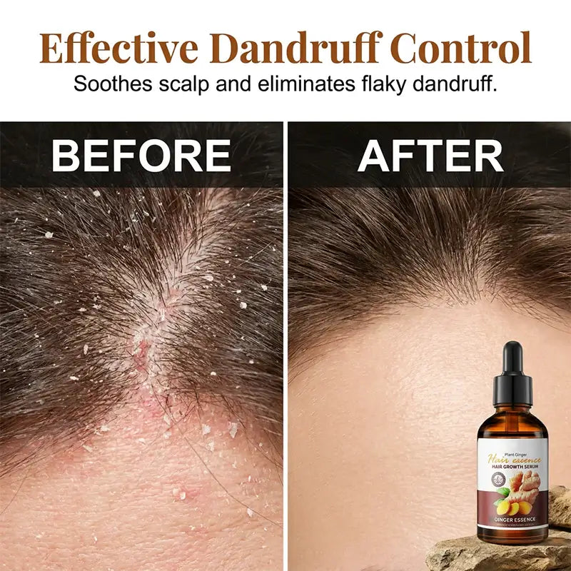 Ginger Anti-Hair Loss Treatment for Hair Growth