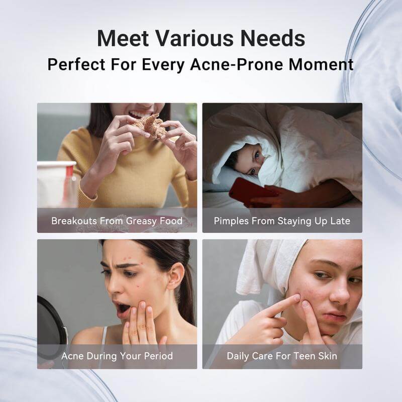 Pimple & Body Acne Treatment Lotion