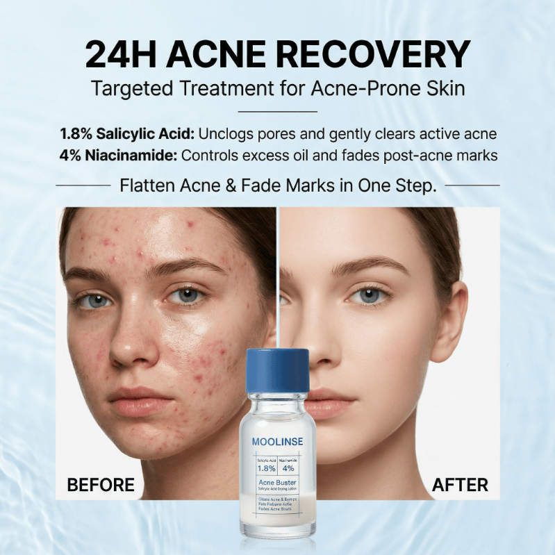 Pimple & Body Acne Treatment Lotion