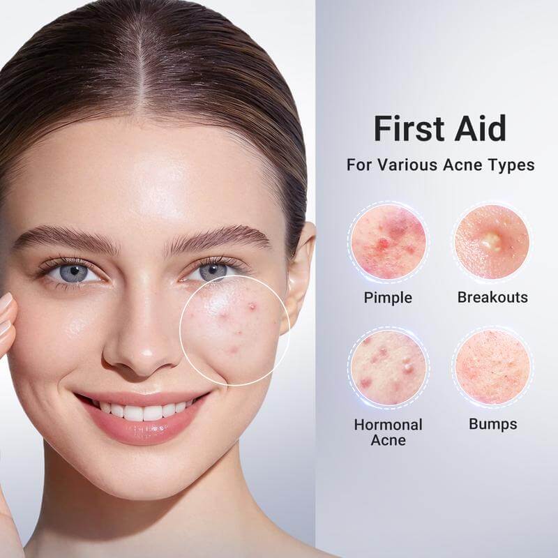 Pimple & Body Acne Treatment Lotion