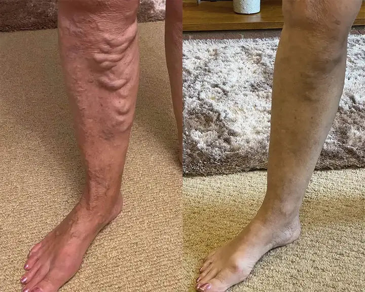 VeinGuard Herbal Spray